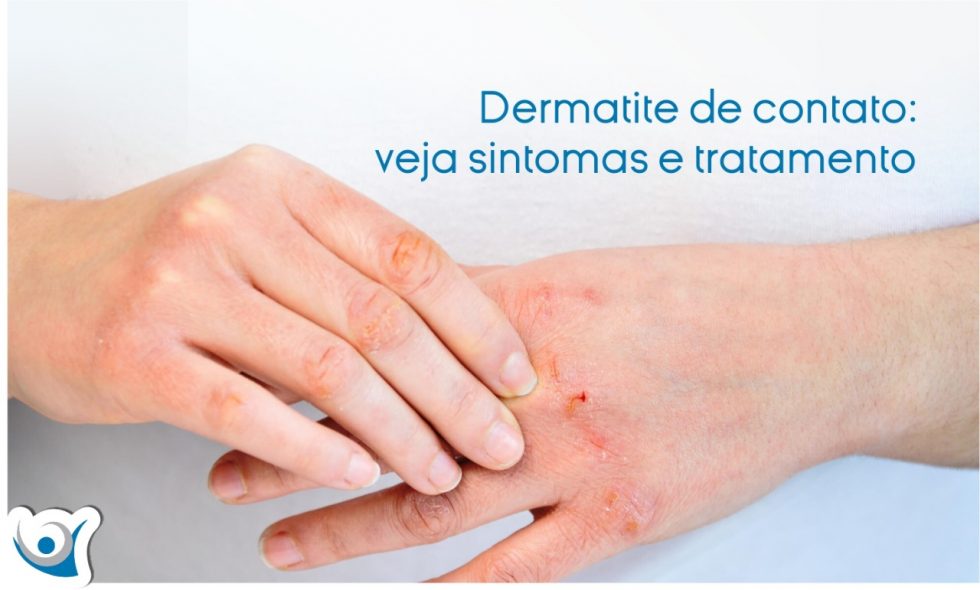 Dermatite de contato veja sintomas e tratamento Alergoclínica