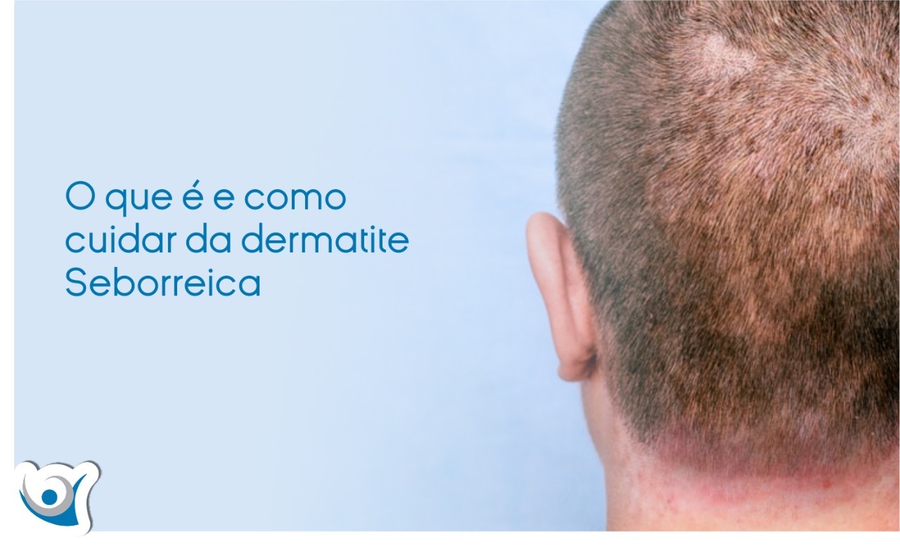 Dermatite seborreica veja as causas e tratamento Alergoclínica