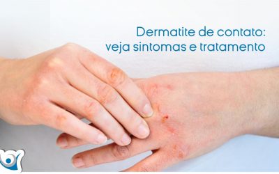Dermatite de contato: veja sintomas e tratamento