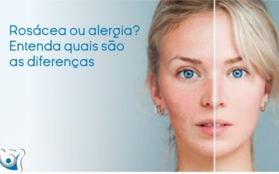 Rosácea ou alergia? Entenda quais são as diferenças