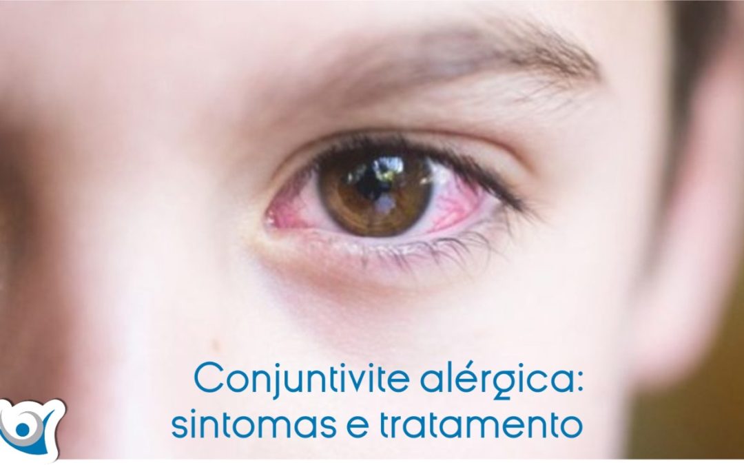 Conjuntivite alérgica sintomas