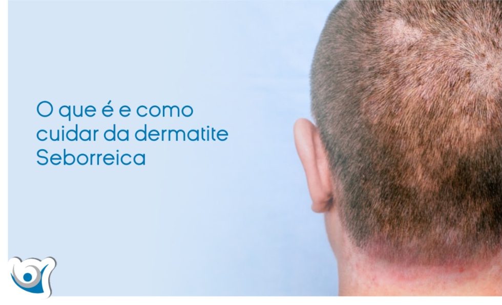 Dermatite Seborreica Veja As Causas E Tratamento Alergocl Nica