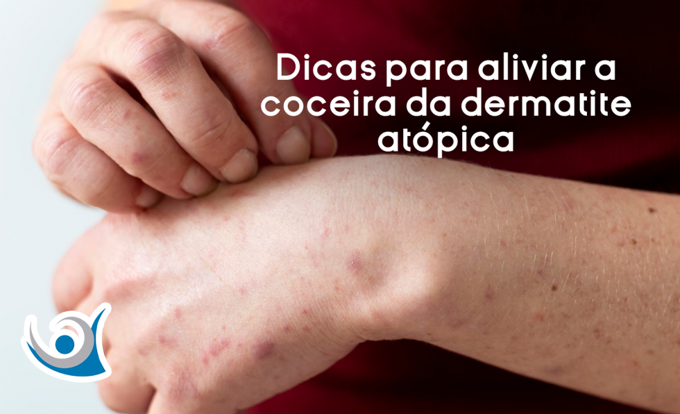 Dicas para aliviar a coceira da dermatite atópica Alergoclínica