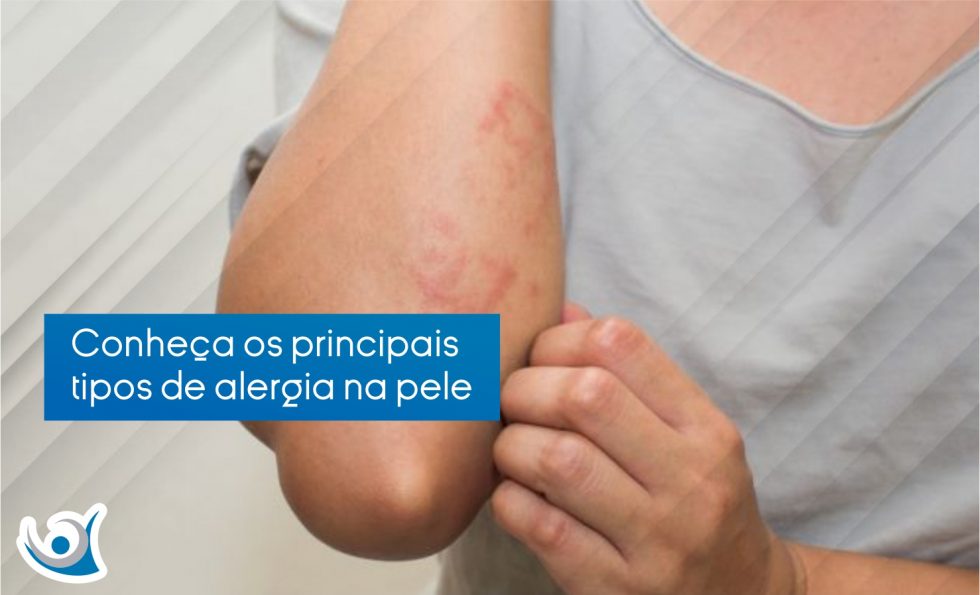 Tipos De Alergia Na Pele: Conheça Os Principais - Alergoclínica