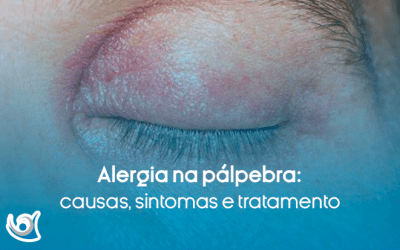 Alergia na pálpebra: causas, sintomas e tratamento