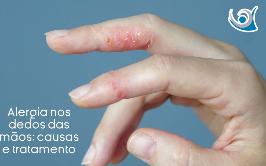 Alergia nos dedos das mãos: causas e tratamento