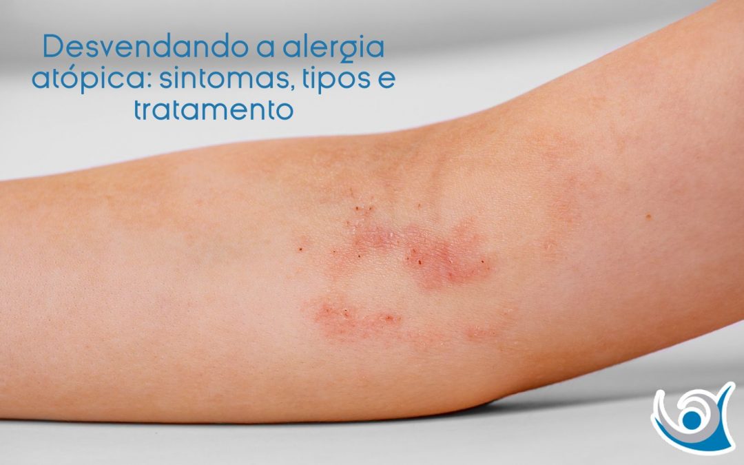 Desvendando a alergia atópica: sintomas, tipos e tratamento