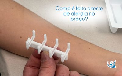 Como é feito o teste de alergia no braço?