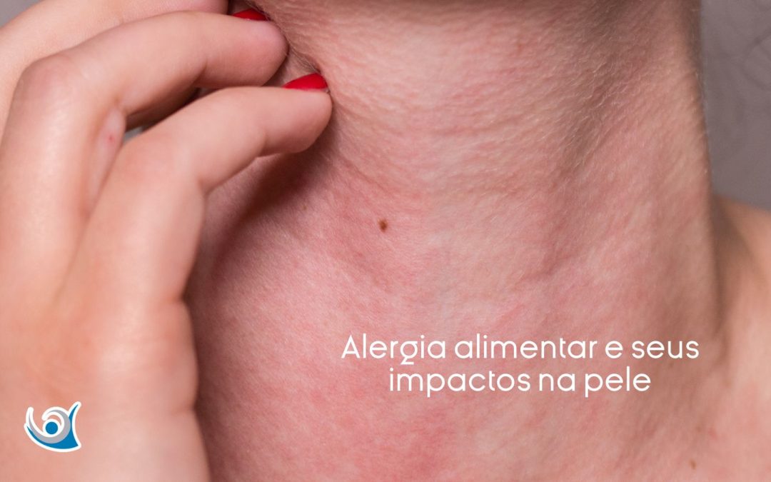 Alergia alimentar e seus impactos na pele