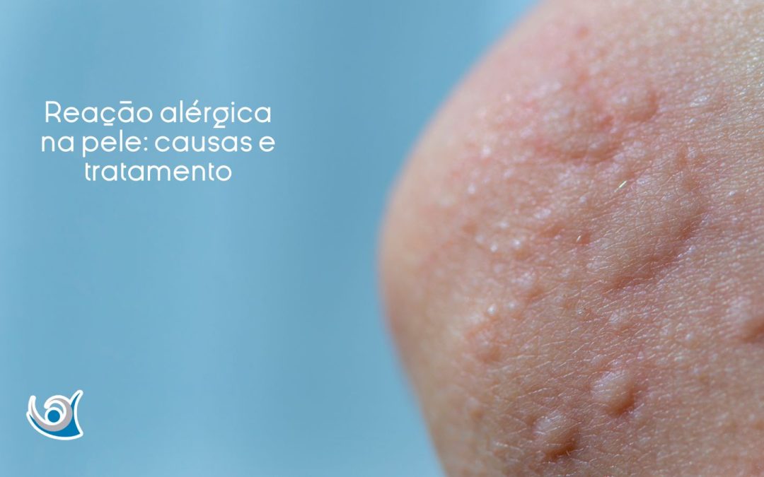 reação alérgica na pele Alergoclínica