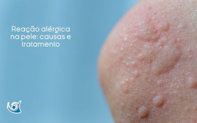 Reação alérgica na pele: causas e tratamento